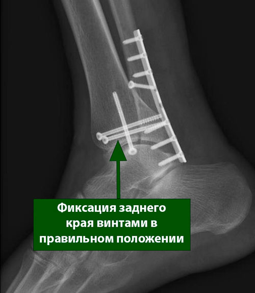 Реферат: Лечение переломов лодыжек с отрывом заднего нижнего края большеберцовой кости